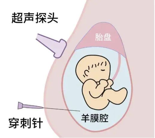 孕期必讀：產(chǎn)前篩查≠產(chǎn)前診斷，區(qū)別在這里！