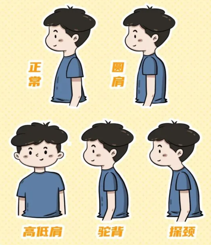 青少年脊柱側(cè)彎：別讓孩子的背，悄悄“彎”了！