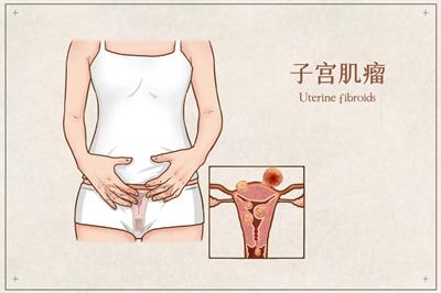 得了子宮肌瘤，一定要手術(shù)切除嗎？